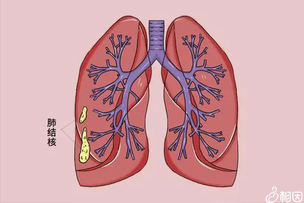 肺出现肺结核