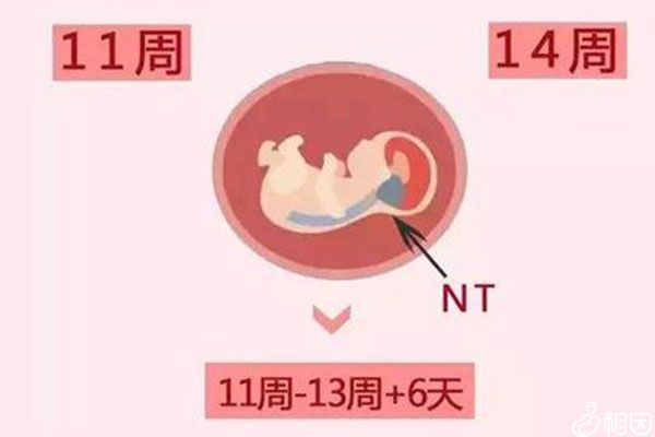 nt检查时间在11-13周期间